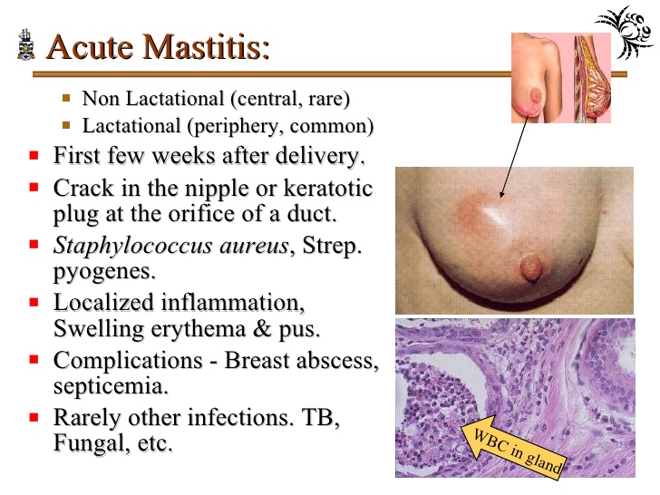 Home Remedies that work for Mastitis while breastfeeding